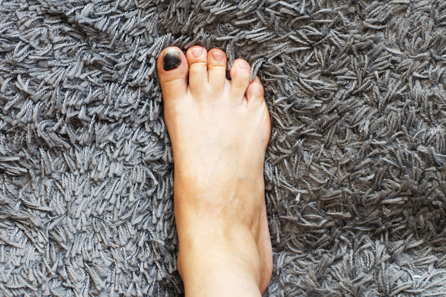 Black Toenail: Causes, Prevention, and Shoe Recommendations