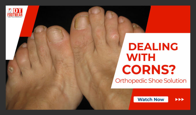 corns on feet