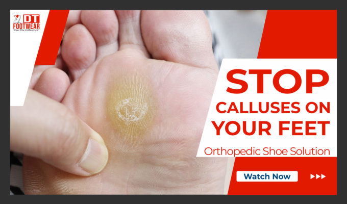 Calluses on feet