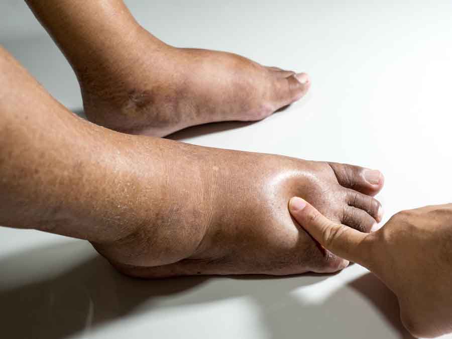 swollen feet - edema