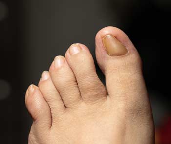 toenail damage