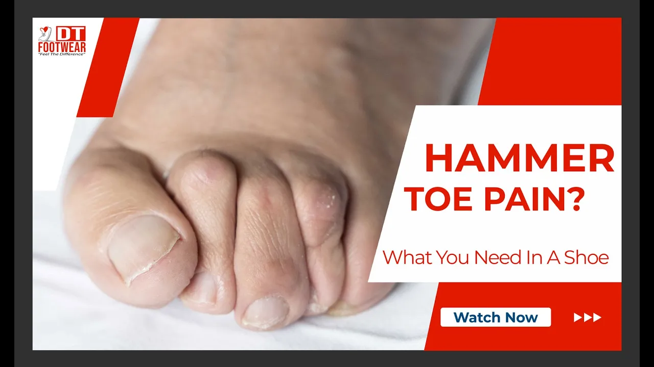 hammertoe foot youtube thumbnail