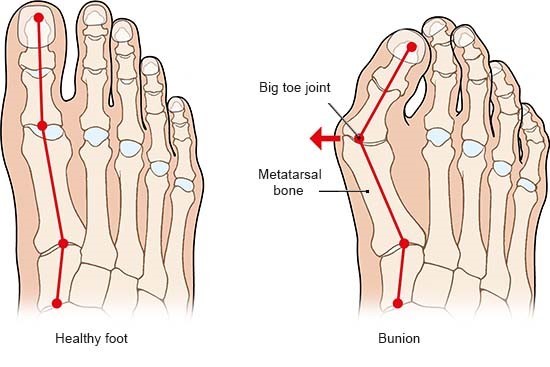 comparison healthy foot and bunion